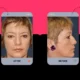 casos antes y después cirugía de ojeras y párpados superiores